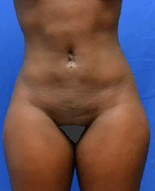 Liposuction Nigeria, Liposuction Abuja