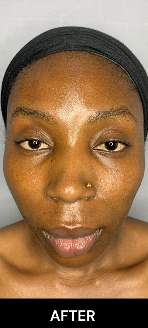 Botox Nigeria