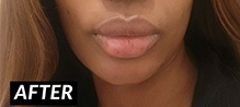 Lip Augmentation Before and After | Flawless Skin