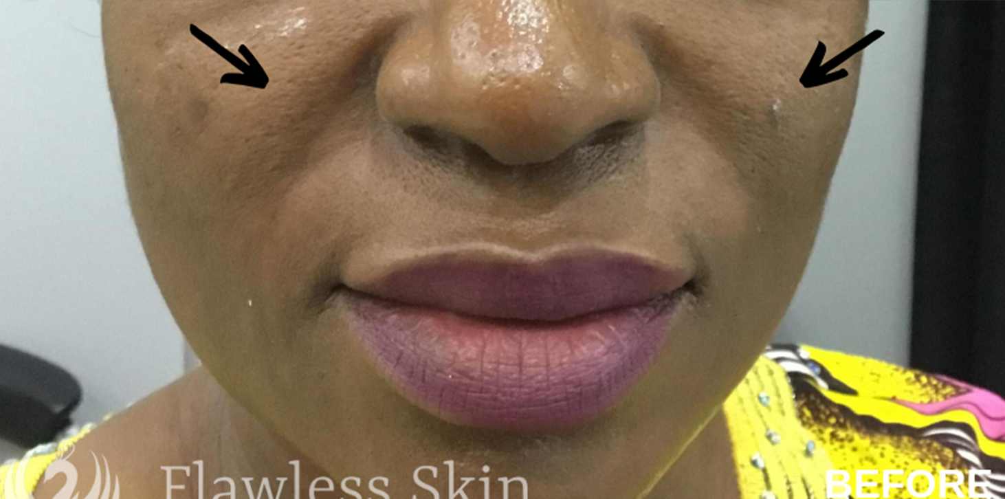 Smile Lines And Nasolabial Fold Fillers Before and After | Flawless Skin