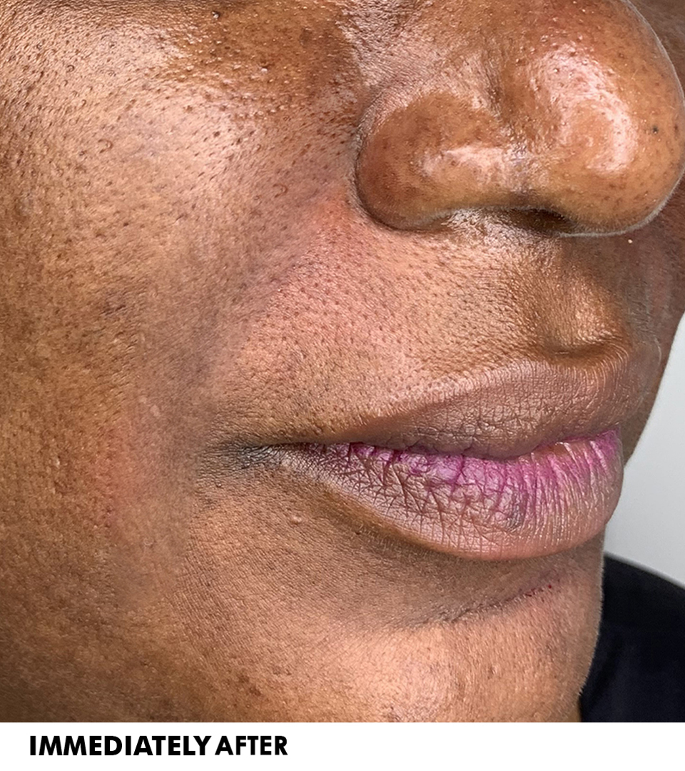 Smile Lines And Nasolabial Fold Fillers Before and After | Flawless Skin