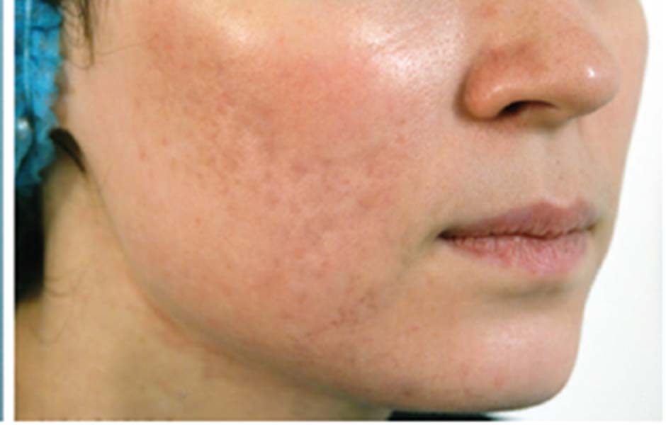 Laser Skin Treatments Before and After | Flawless Skin