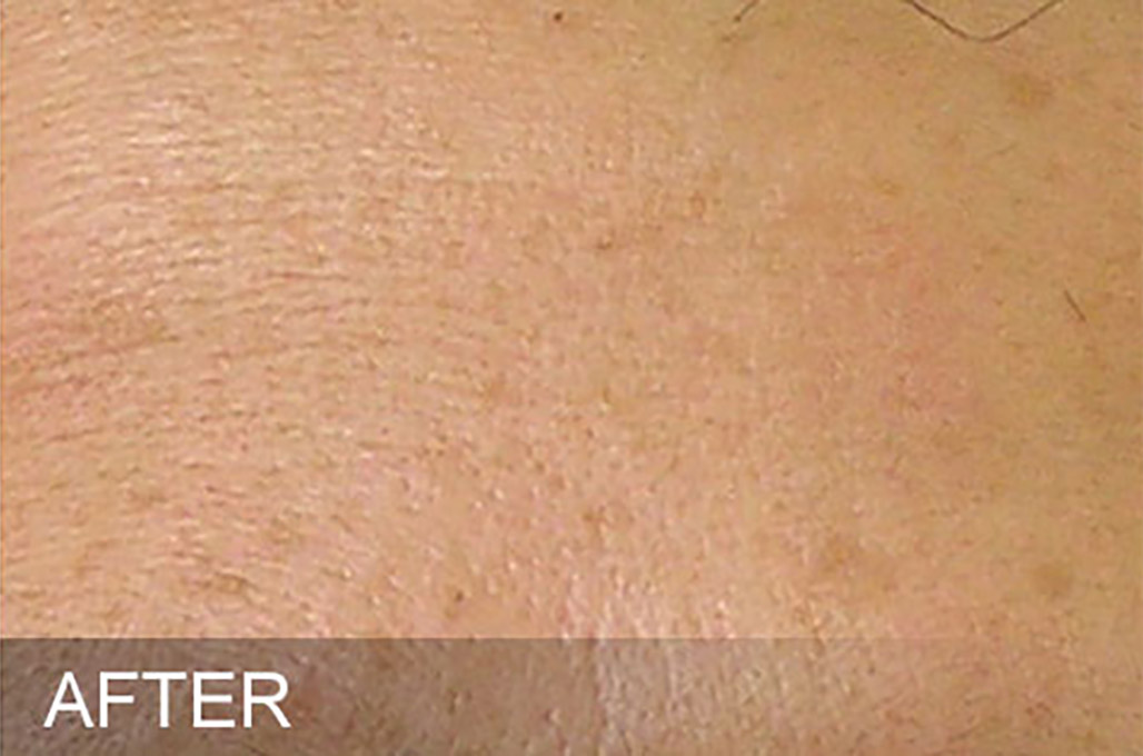 Hydrafacial Before and After | Flawless Skin
