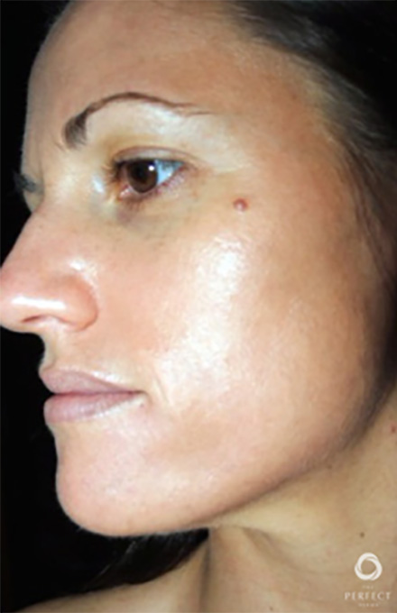 Specialty Peels Before and After | Flawless Skin