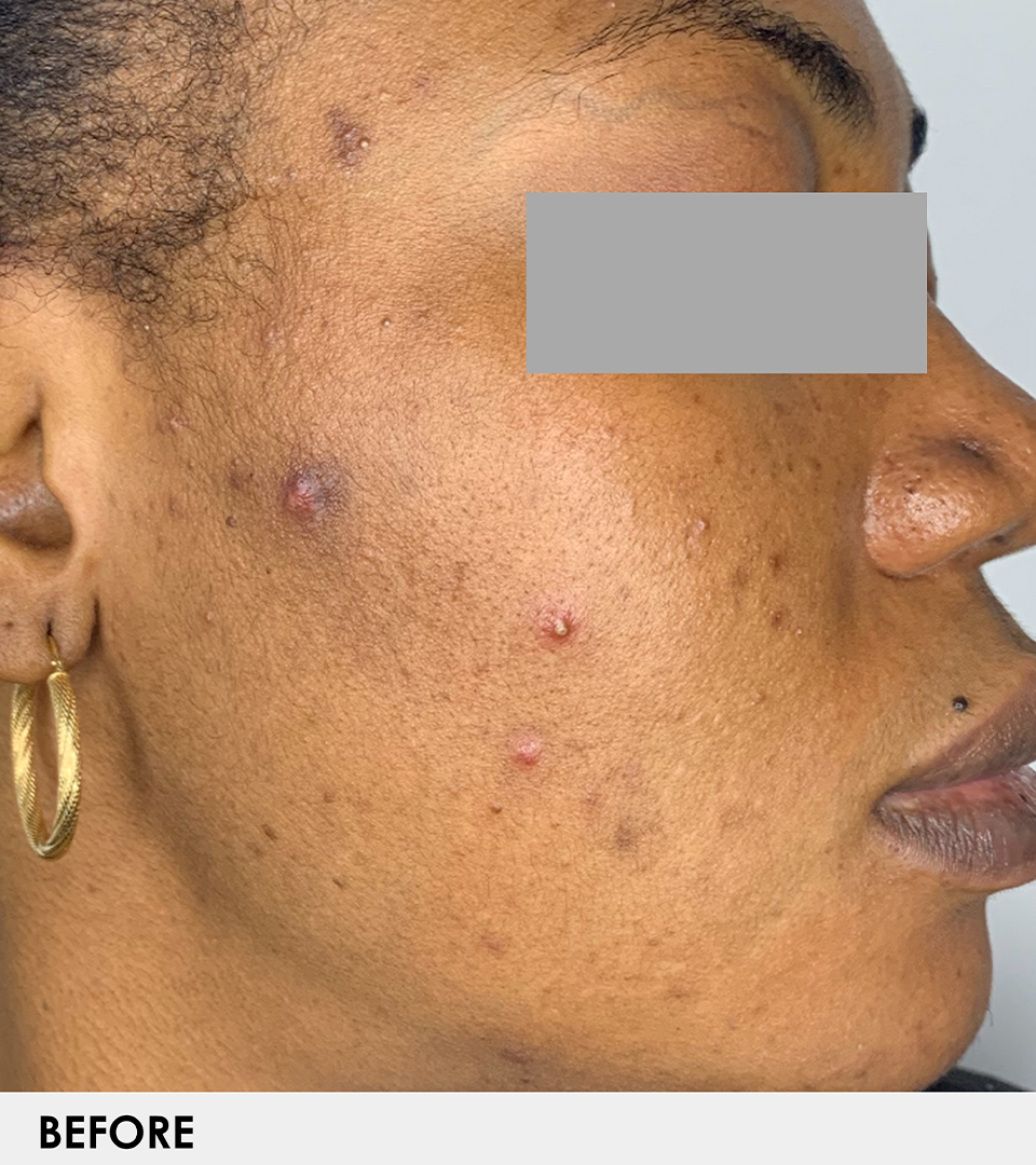 Microneedling With Prp Before and After | Flawless Skin