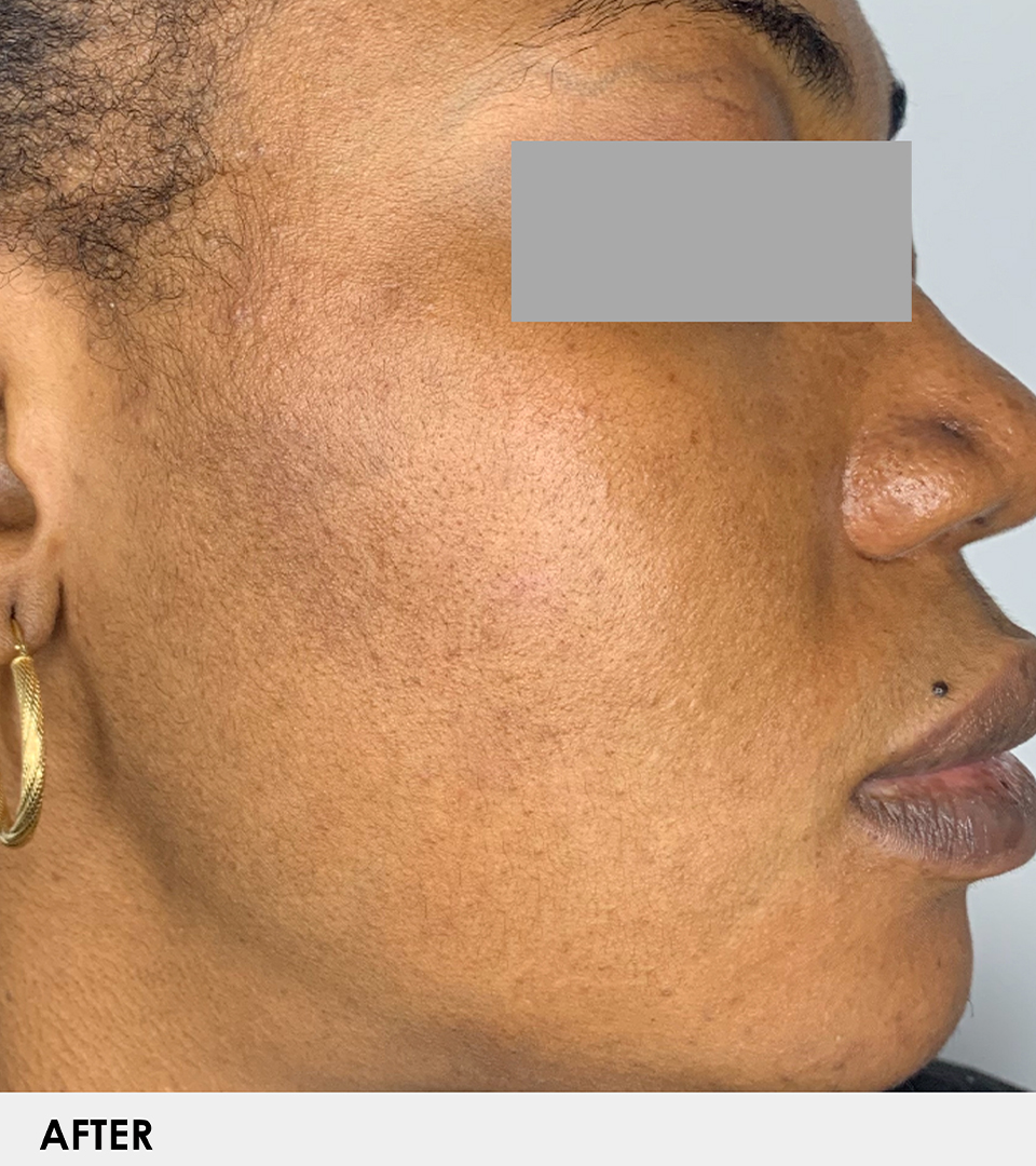 Microneedling With Prp Before and After | Flawless Skin
