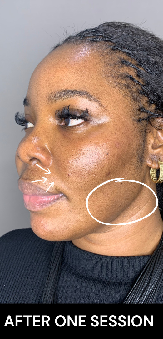 Morpheus8 Before and After | Flawless Skin